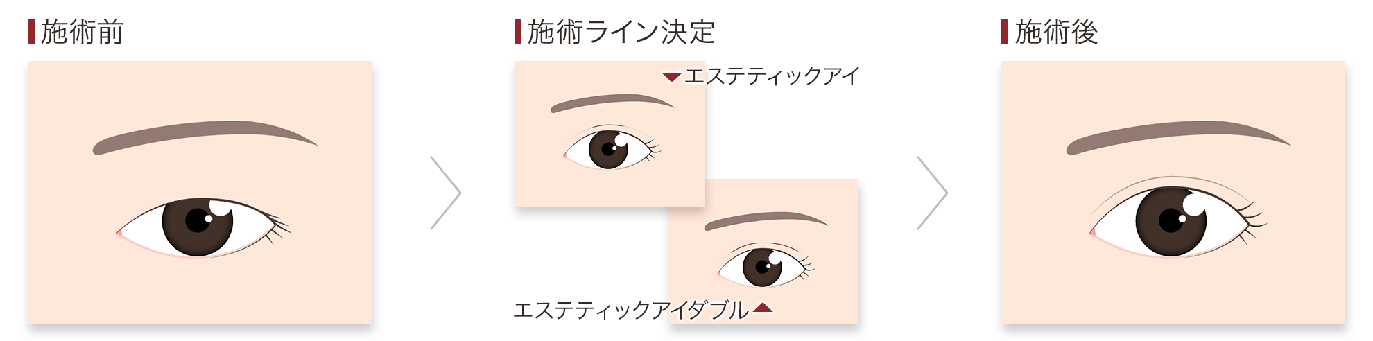 エステティックアイ 施術の流れ