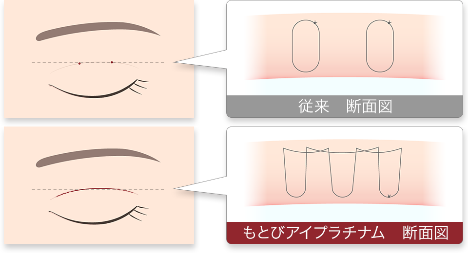もとびアイプラチナム 施術の解説