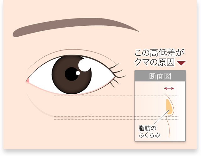 裏ハムラ 目の下高低差断面