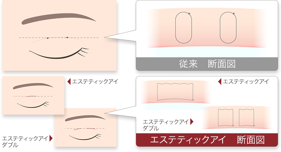 二重埋没法 エステティックアイ 断面