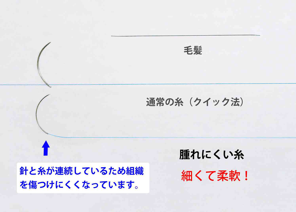 二重埋没法 腫れにくい糸 しなやか
