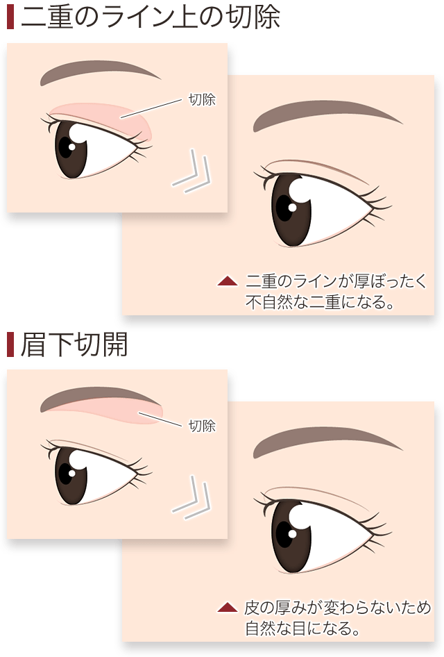 全切開たるみ取り 二重 眉下