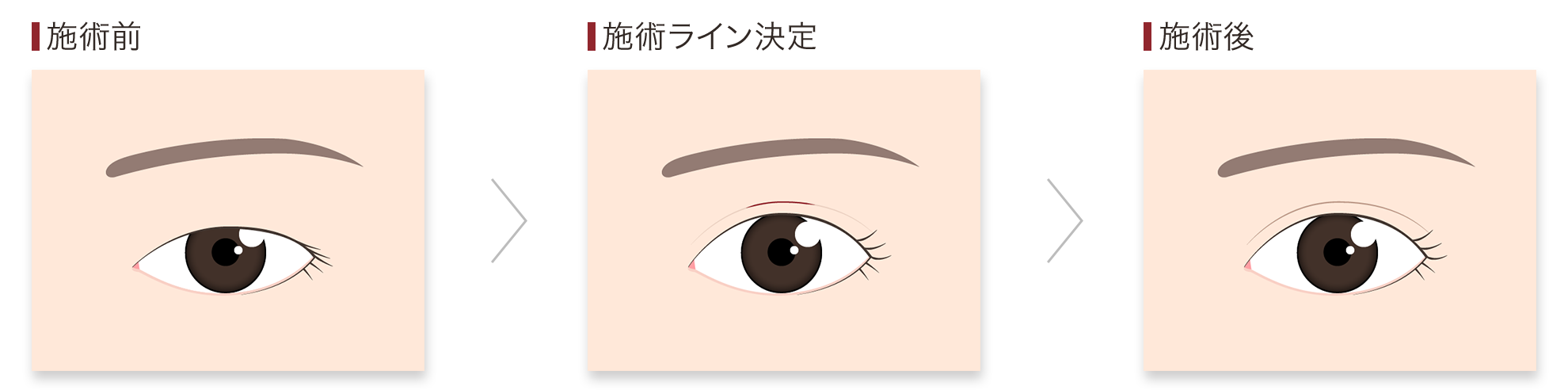 プチ二重術 施術の流れ 吸収糸 溶ける糸