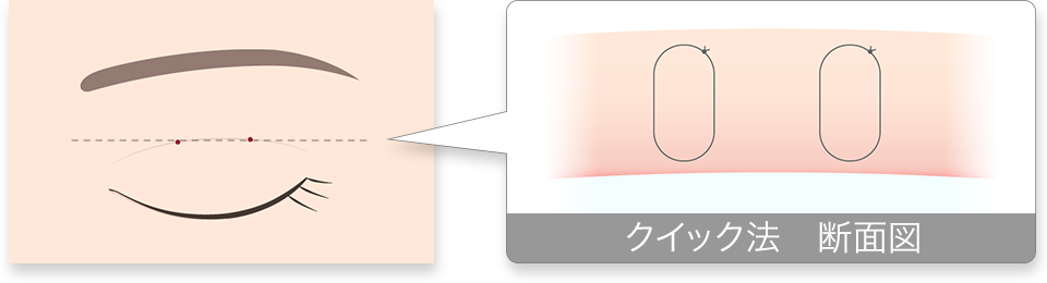 二重埋没法 クイック法 断面図