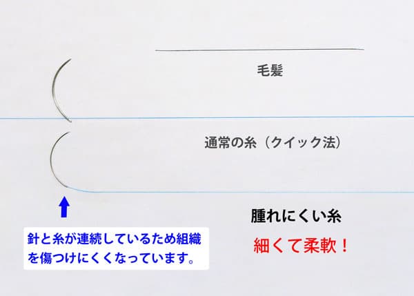 埋没法で使う腫れにくい針と糸の画像