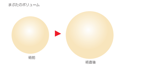 まぶたのボリュームイメージ