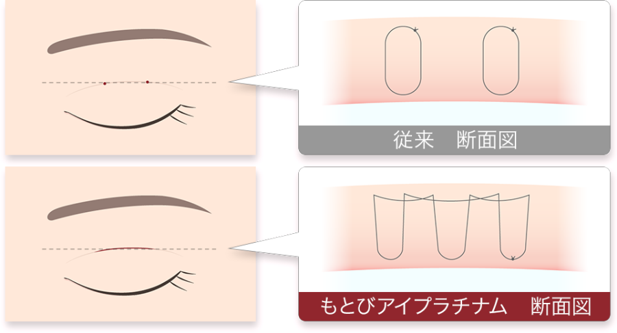 もとびアイプラチナム　糸のかけ方　解説