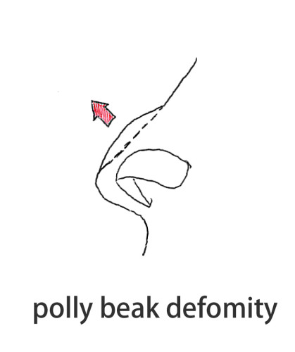 polly beak defomity