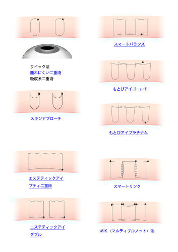 埋没法の図