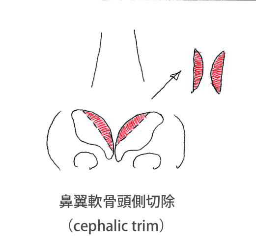 鼻尖形成、軟骨移植