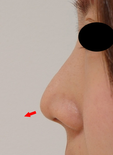 鼻尖形成（3D法）、flap法　1ヶ月後　左側面