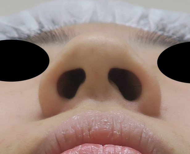 鼻尖形成（3D法）、flap法　手術前　下から