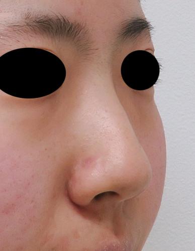 鼻尖形成（3D法）、flap法　手術前　右斜め