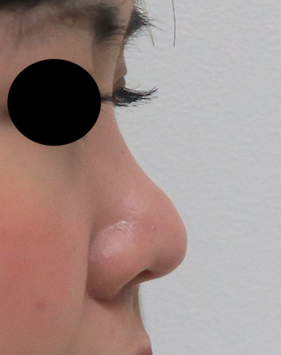 鼻尖形成、軟骨移植（耳珠）　1か月　右側面