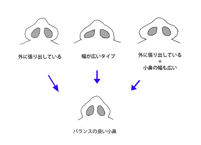 小鼻の種類