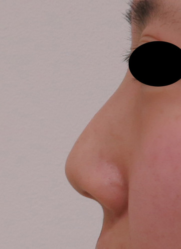 鼻尖形成（3D法）、flap法　手術前　左側面