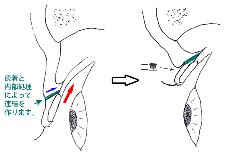 二重瞼　切開法図