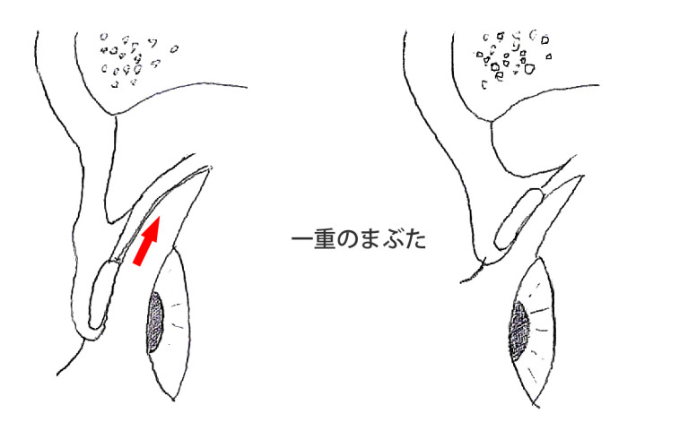 一重まぶたの説明図