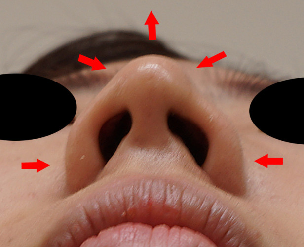 鼻尖形成（3D法）、flap法　1ヶ月後　下から矢印2