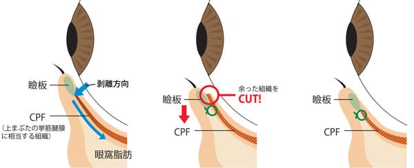 切るたれ目術（下眼瞼下制）の手術のイラスト