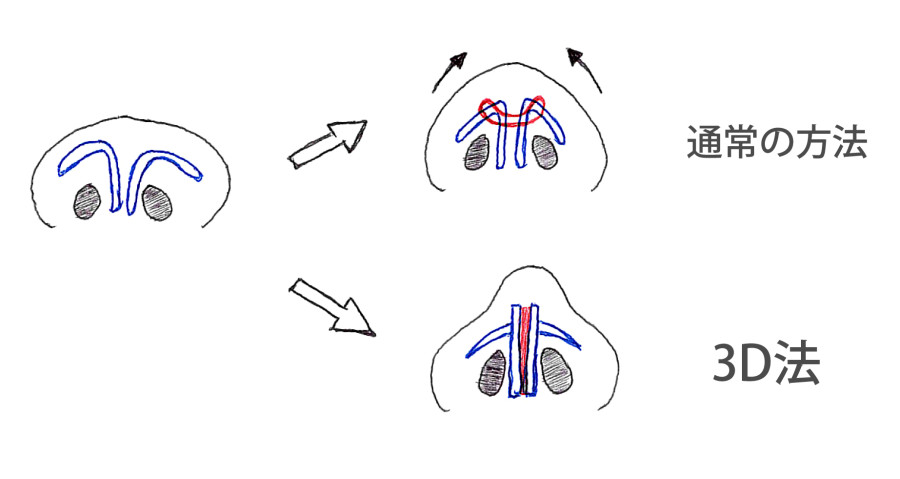 鼻尖形成（3D法）、flap法　