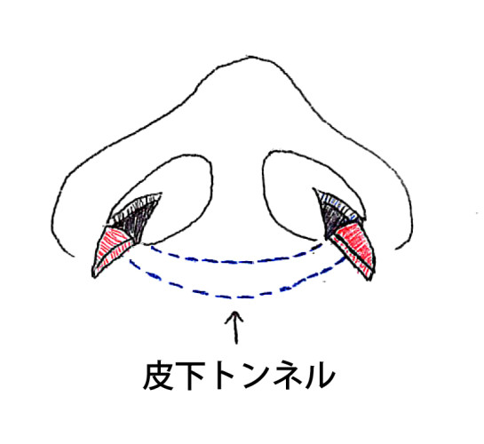 皮下トンネル