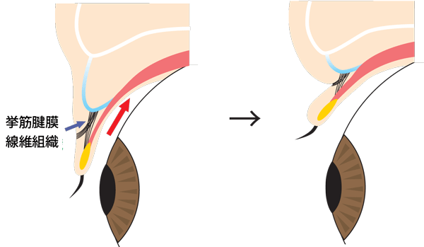 二重まぶたの目を開いたり閉じたりしたときの断面図