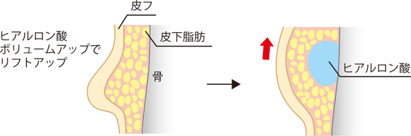 ヒアルロン酸でボリュームアップ＋リフトアップ