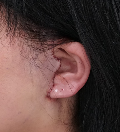 DSC01207左耳傷
