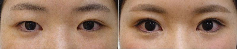 左右差のある瞼の二重埋没法症例写真
