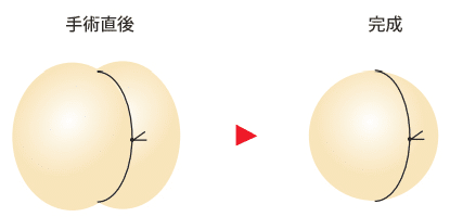 埋没法の適正な糸のテンション