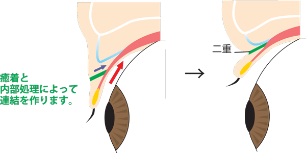 二重術の構造（断面図）