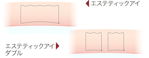 二重埋没法の糸のかけ方の図（エステティックアイ）