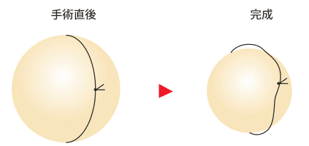 糸を緩くかけた図