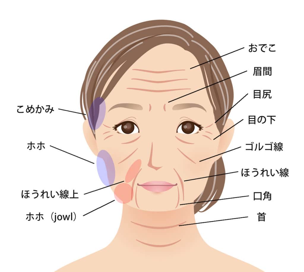 しわ（凹凸）の図