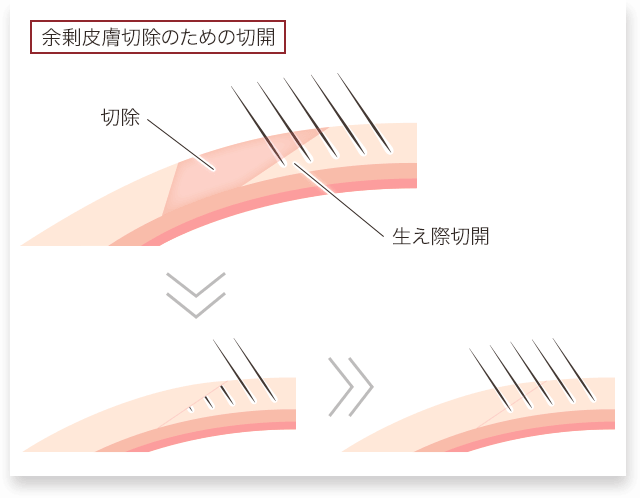 眉下切開 毛包斜切開