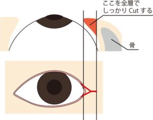 目尻切開全層切開縦横