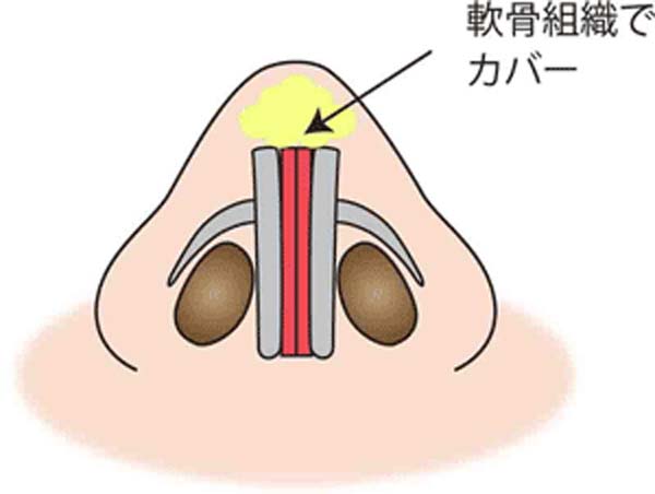 鼻尖縮小(３D法)の先端を軟部組織でカバー