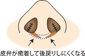 皮弁が癒着して後戻りしにくくなる