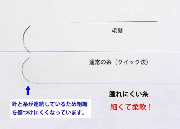 腫れにくい糸　二重埋没法