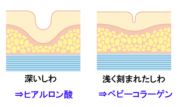 深いしわ、浅く刻まれたしわが適したフィラー