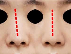 プロテーゼで鼻スジの傾きを整えるイメージ