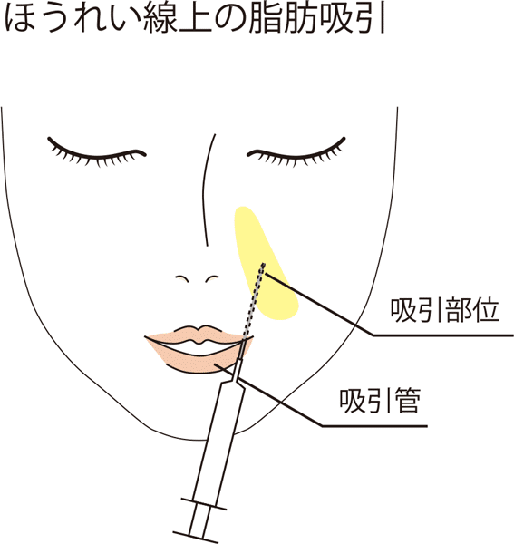 法令線上の脂肪吸引