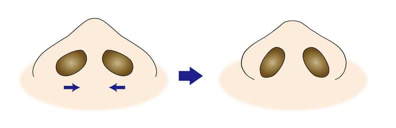 小鼻縮小の内側法だけの場合は小鼻の張り出しが強調される