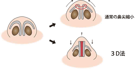 通常の鼻尖縮小と３D法 鼻翼軟骨