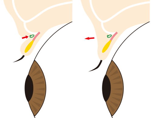 上まぶたの脂肪取り　厚み取り　二重埋没法