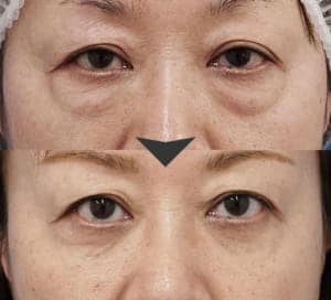 目の下のたるみがある人のし脂肪取り・脂肪注入
