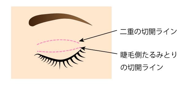 二重切開たるみとり切除部分の違い