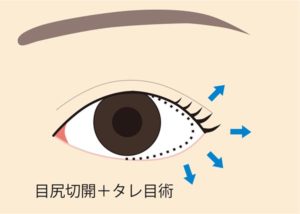 タレ目術の際の目尻切開