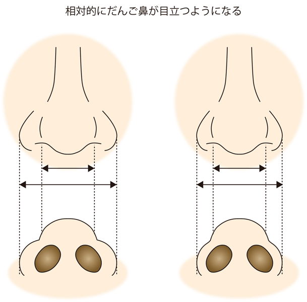 小鼻縮小、相対的に団子鼻が目立つようになる